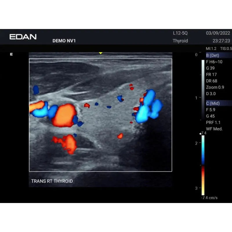 Edan Acclarix AX3 Veterinary Portable Ultrasound Machine