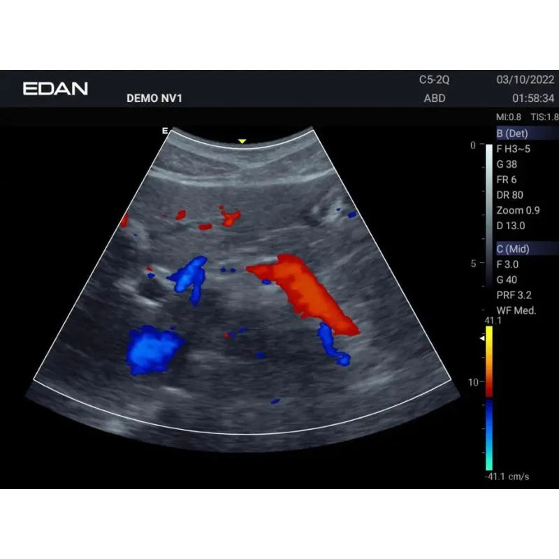 Edan Acclarix AX3 Veterinary Portable Ultrasound Machine